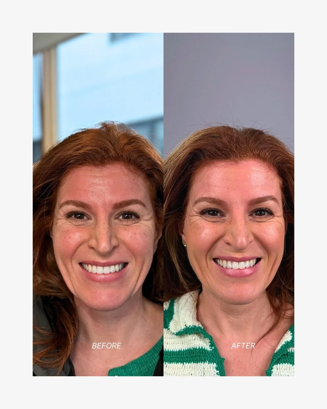 This skin was 3 years in the making 😮&zwj;💨🫶🏼

I love sharing the magic of a collab. In this case - my patient &amp; mine! This beautiful patient (inside &amp; out) has trusted me with her aesthetic treatments for the past 3+ years, but the credi