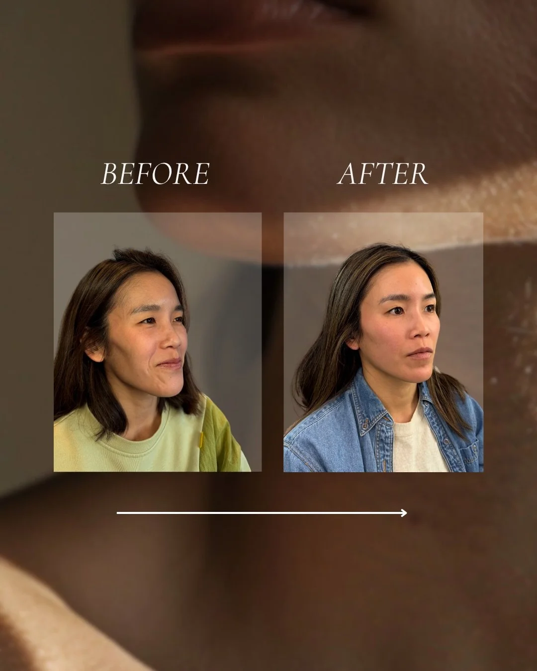 I can still hear her laugh while I write this - that&rsquo;s why I love this before &amp; after. I look forward to every time I see her name on my books&nbsp;🥹

This patient has trusted me with her injectable journey for over 3 years now, starting w