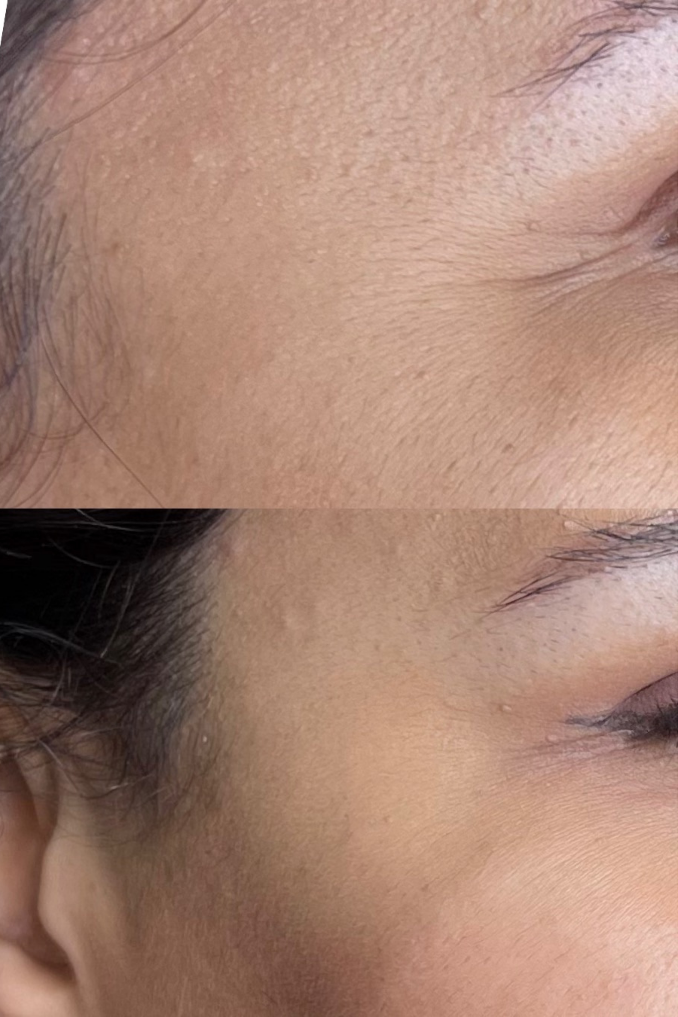BOTOX SIDE EYE .png