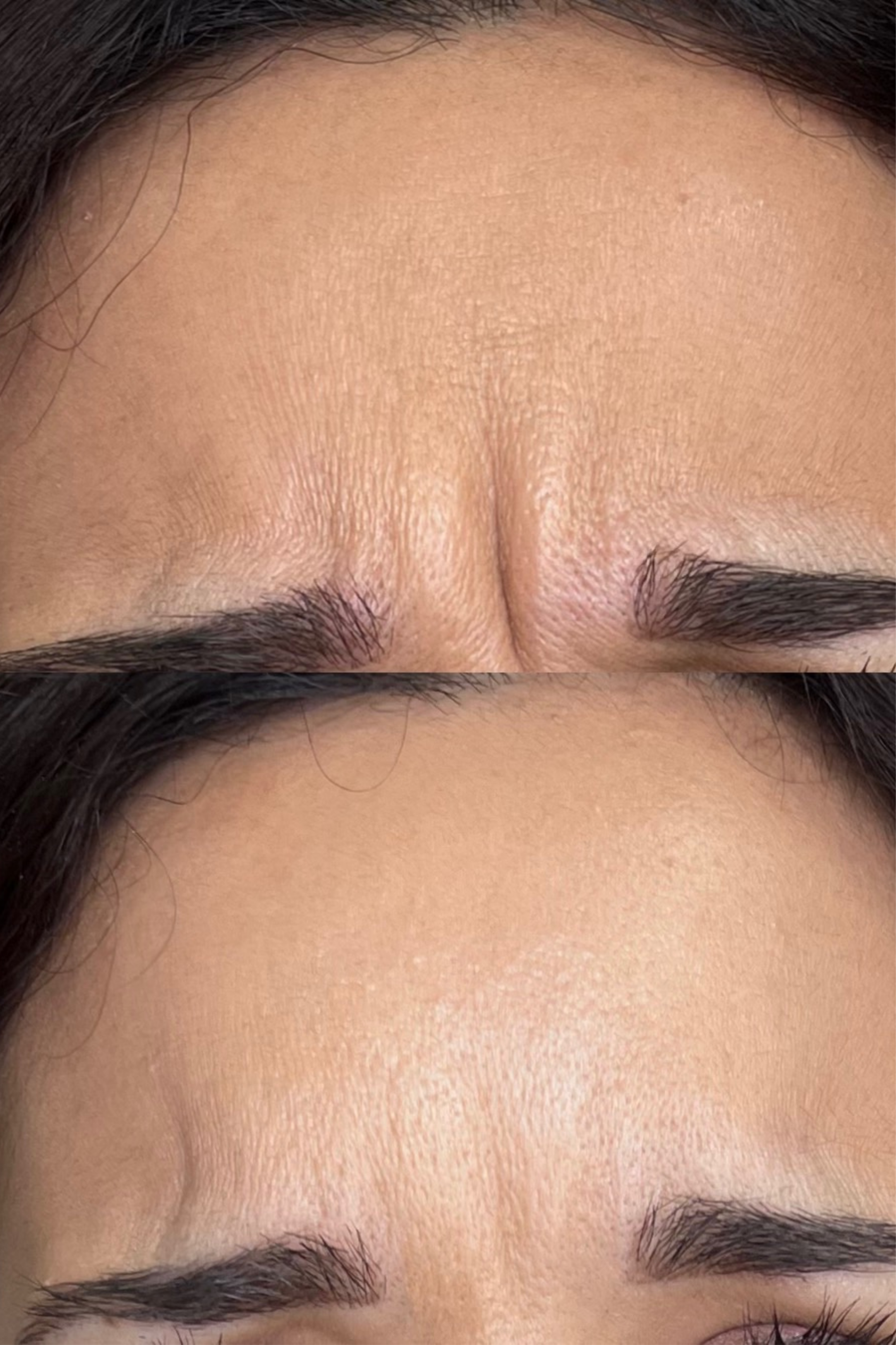 BOTOX FRONT .png