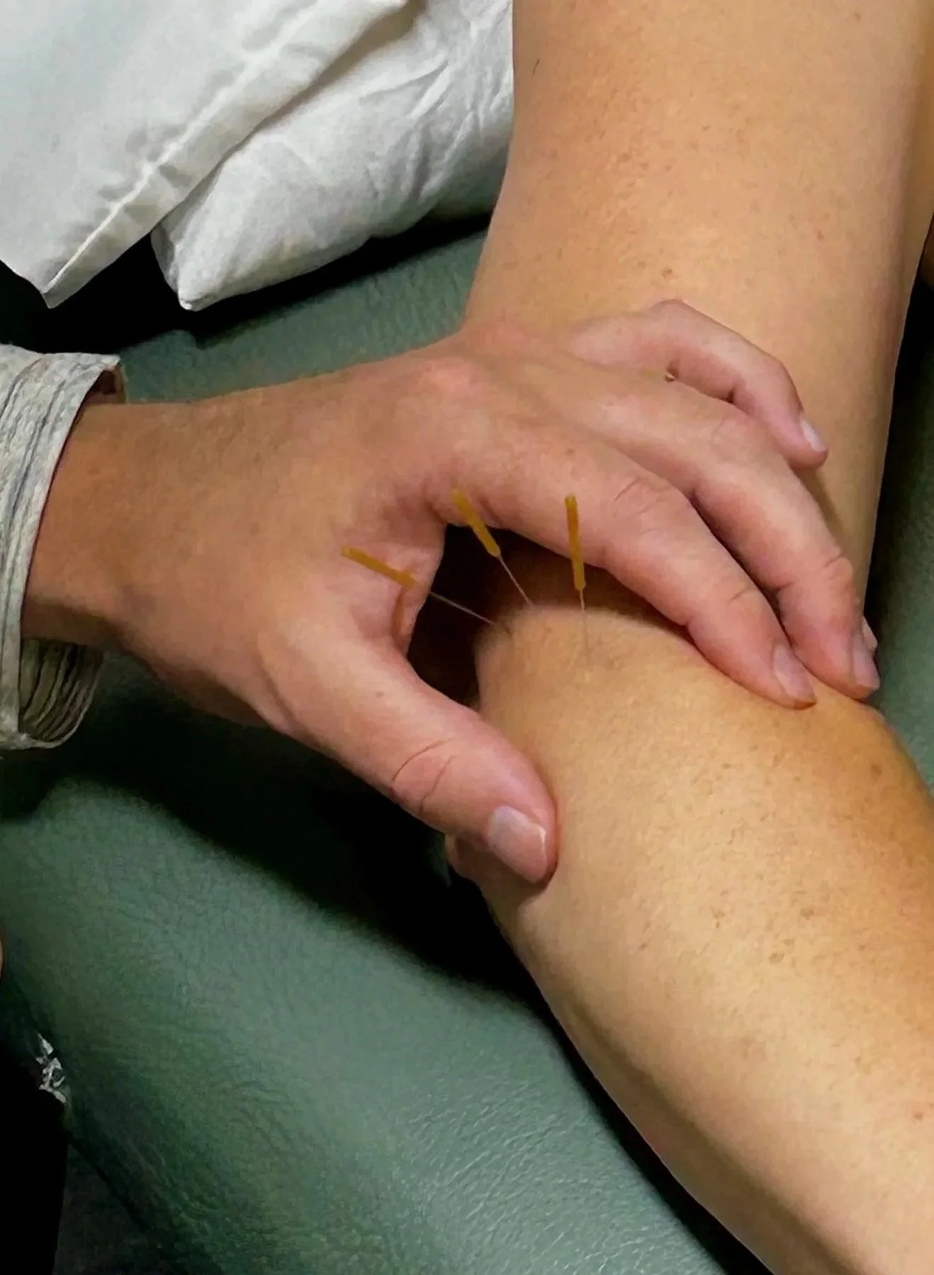 Close-up of a person receiving acupuncture with a thin needle inserted into the neck area.