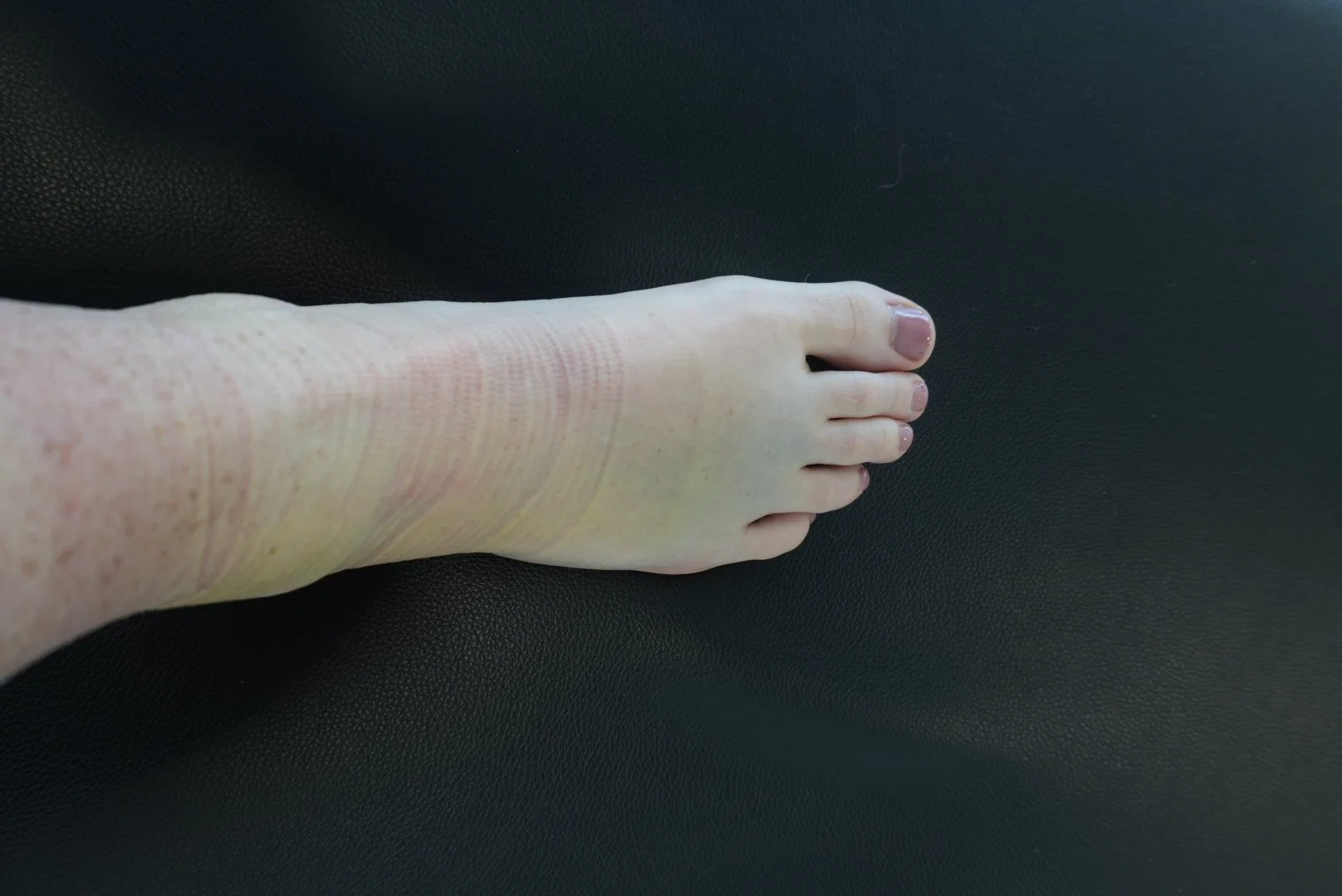 swelling.JPG