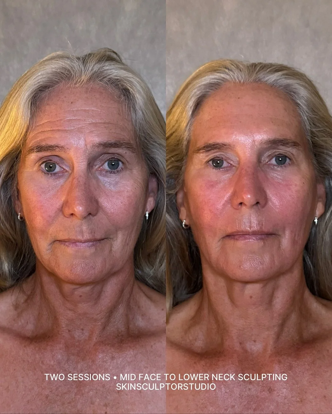 This is a chef’s kiss result! 🤌🏻
After just 2 AgeSculpt™ sessions! Uff!! What can I say… you all know I can’t reverse age, but with me, 50s are the new 30s!! 30s are the new 20s and of course!! 60s are the new 40s!! 😉
He