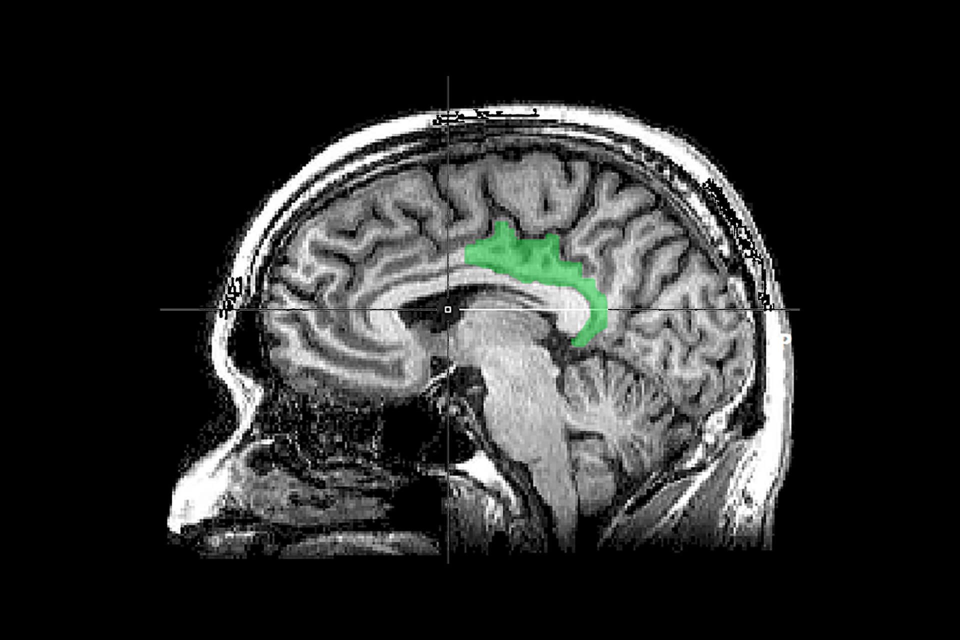 How the Brain Stores Traumatic Memories