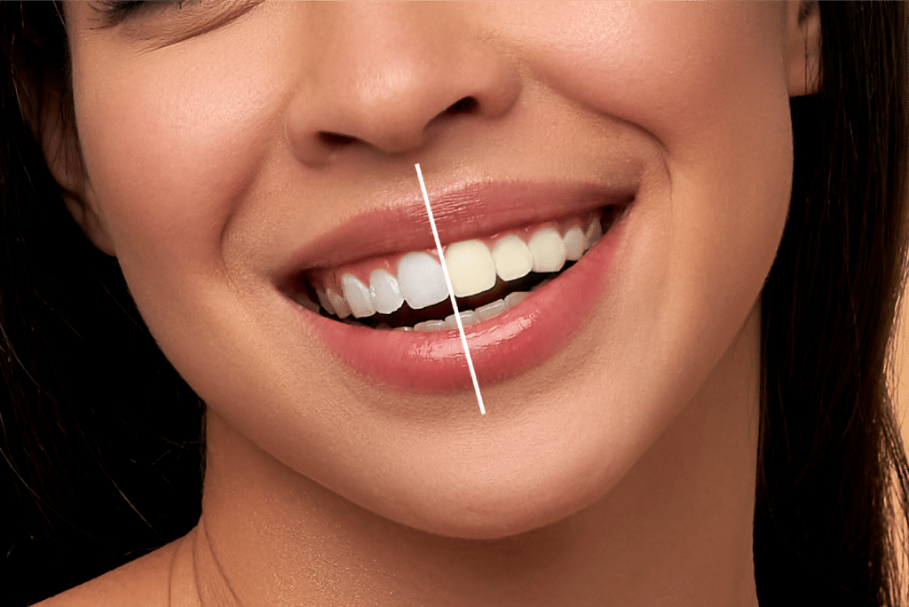 teeth_whitening.png