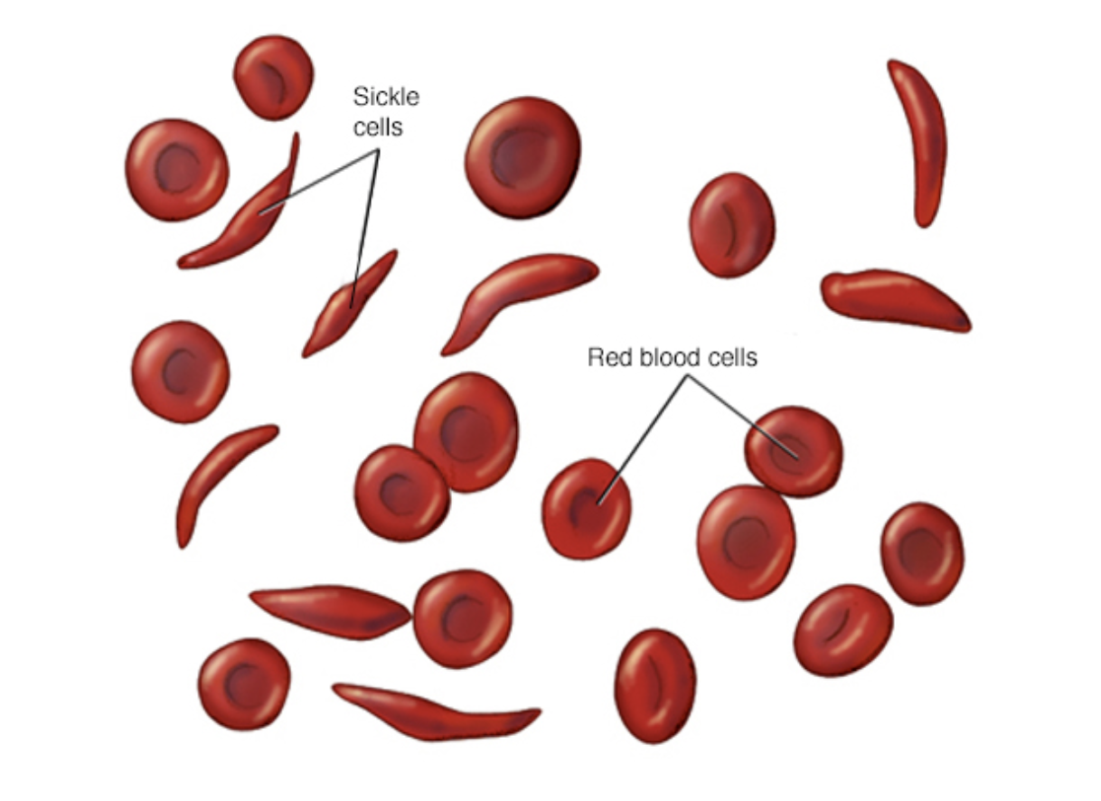 Sickle-cell-anemia.png