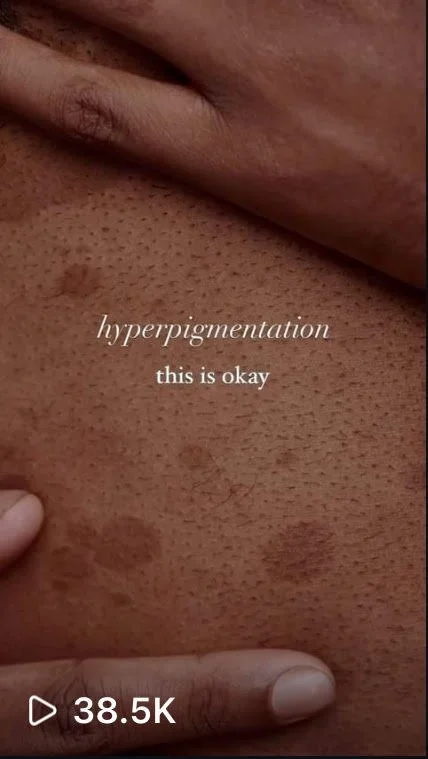 hyperpigmentation.jpg