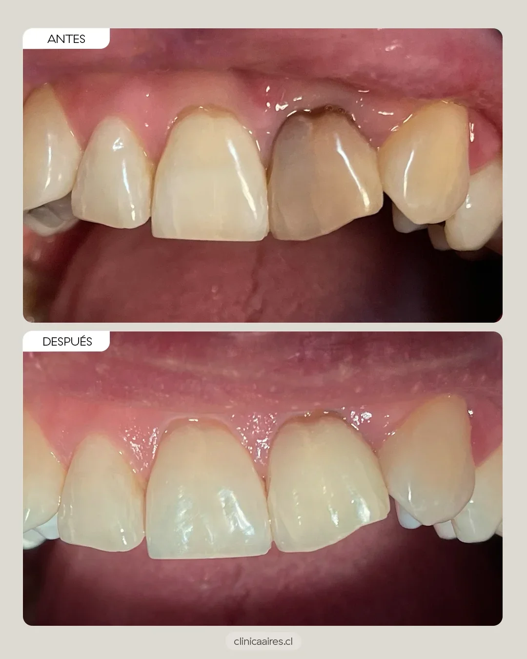 Antes y después de caso de paciente tratado con blanqueamiento dental interno.