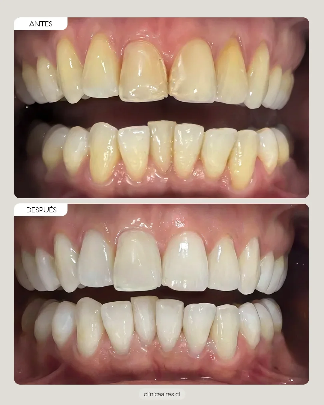 Antes y después de caso real de paciente con blanqueamiento dental externo.