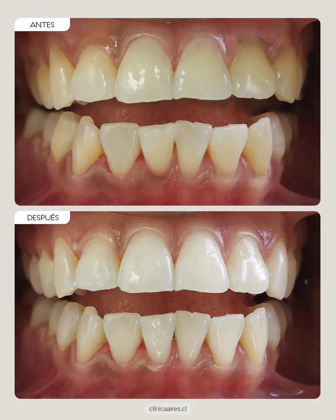 Comparativa de antes y después de un blanqueamiento dental.