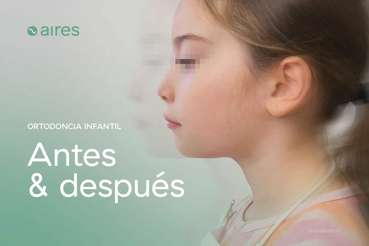 Antes y después de ortodoncia en niños: mandíbula retruida