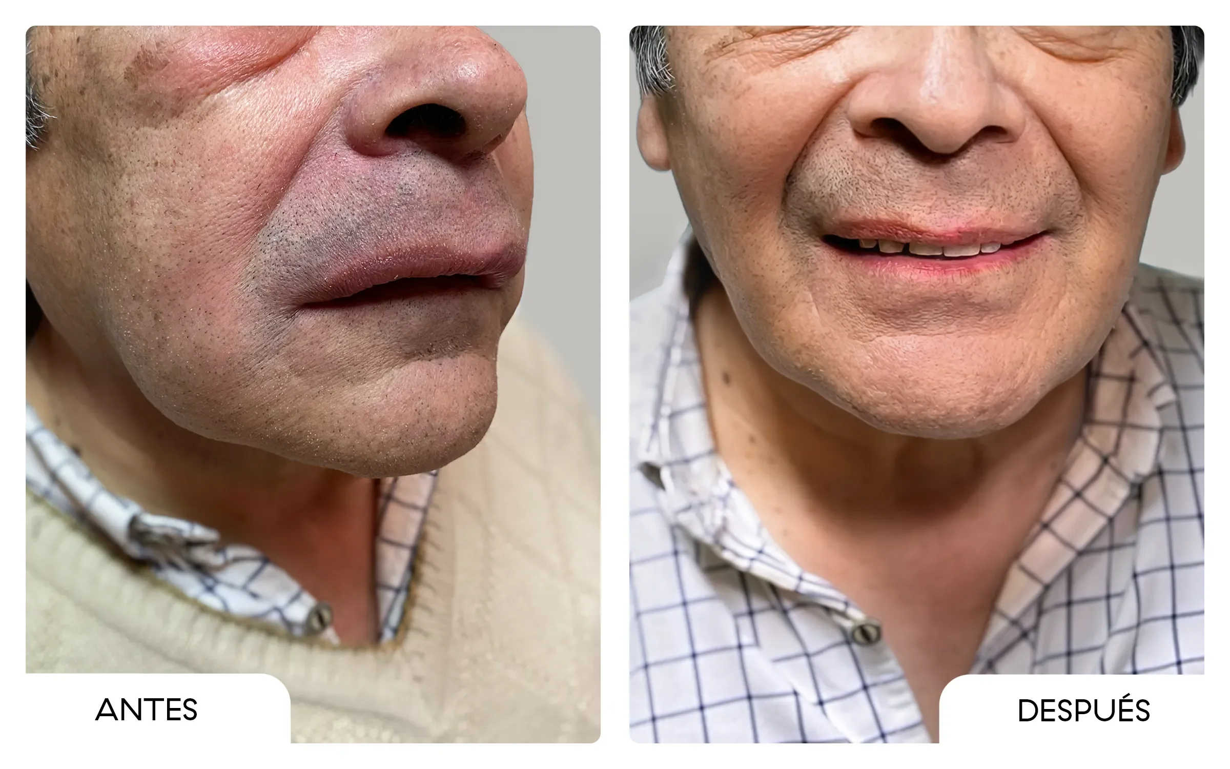 Antes y después de un tratamiento de conducto, a la izquierda un hombre con inflamación facial, después a la derecha el mismo hombre sonriendo sin inflamación.