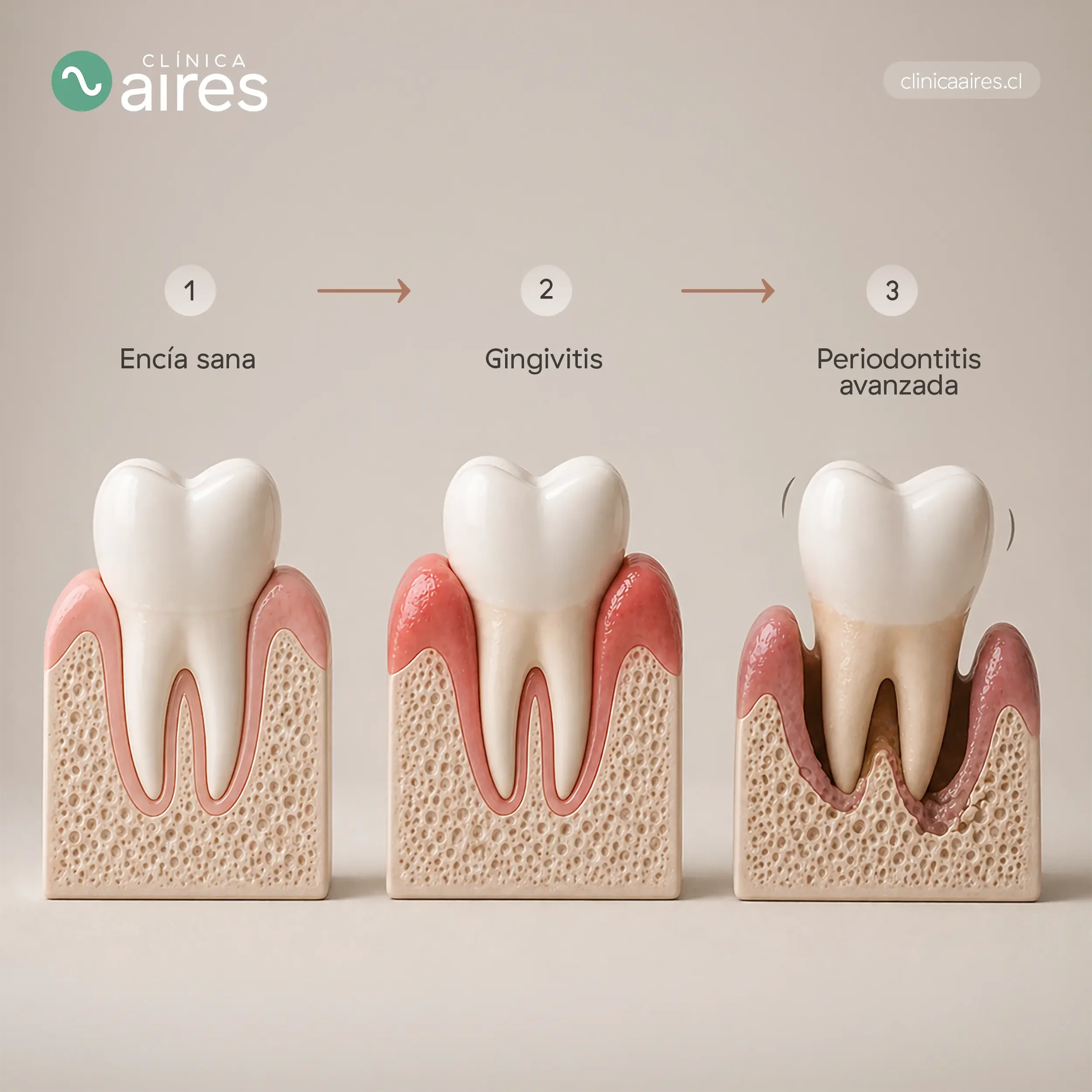 Imagen educativa sobre periodontitis que muestra la progresión desde encía sana a gingivitis y periodontitis avanzada, con retracción de encías y pérdida de hueso dental.