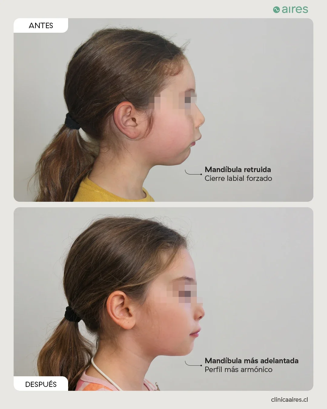 Antes y después de ortodoncia interceptiva en niña con mandíbula retruida.