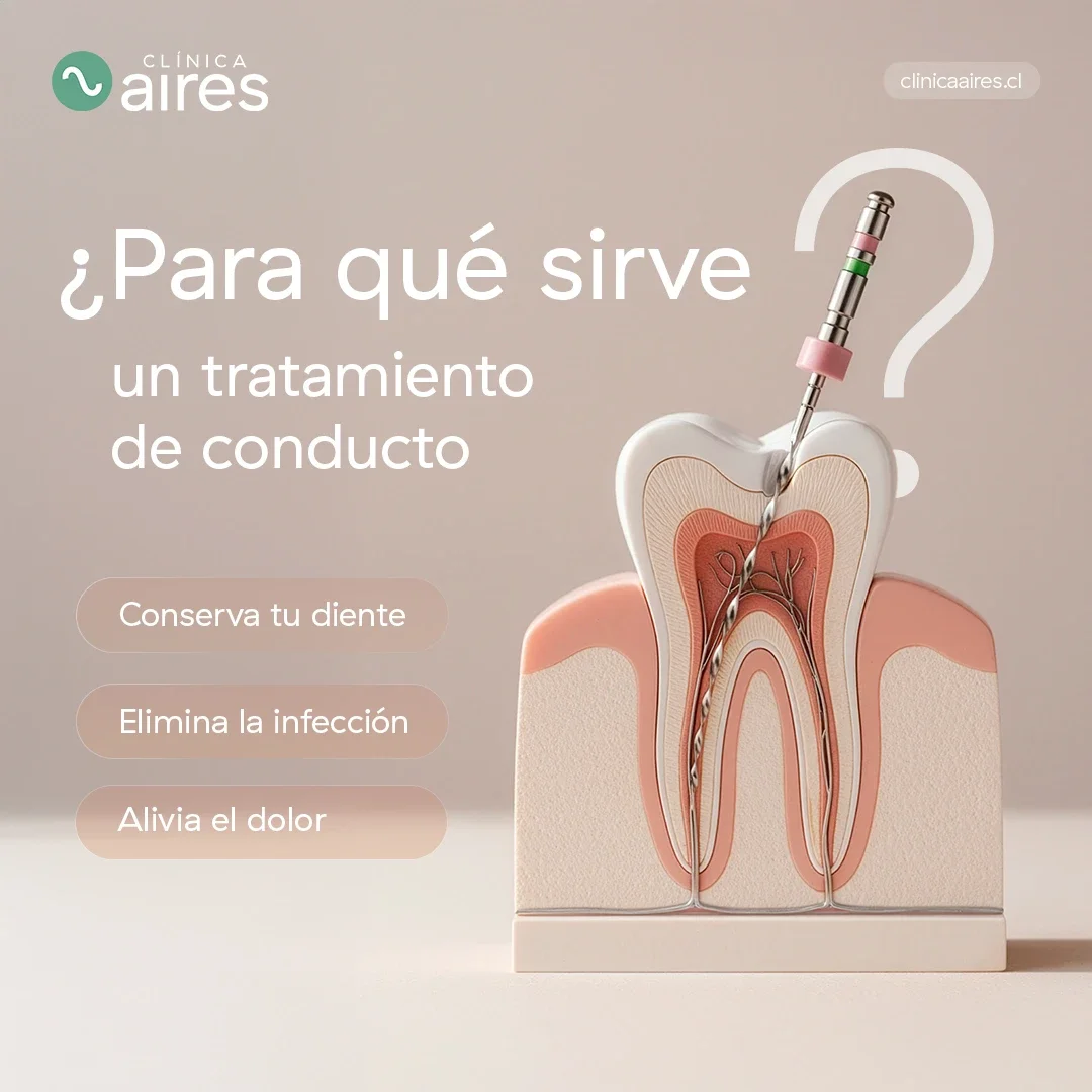 ¿Para qué sirve un tratamiento de conducto? Infografía.