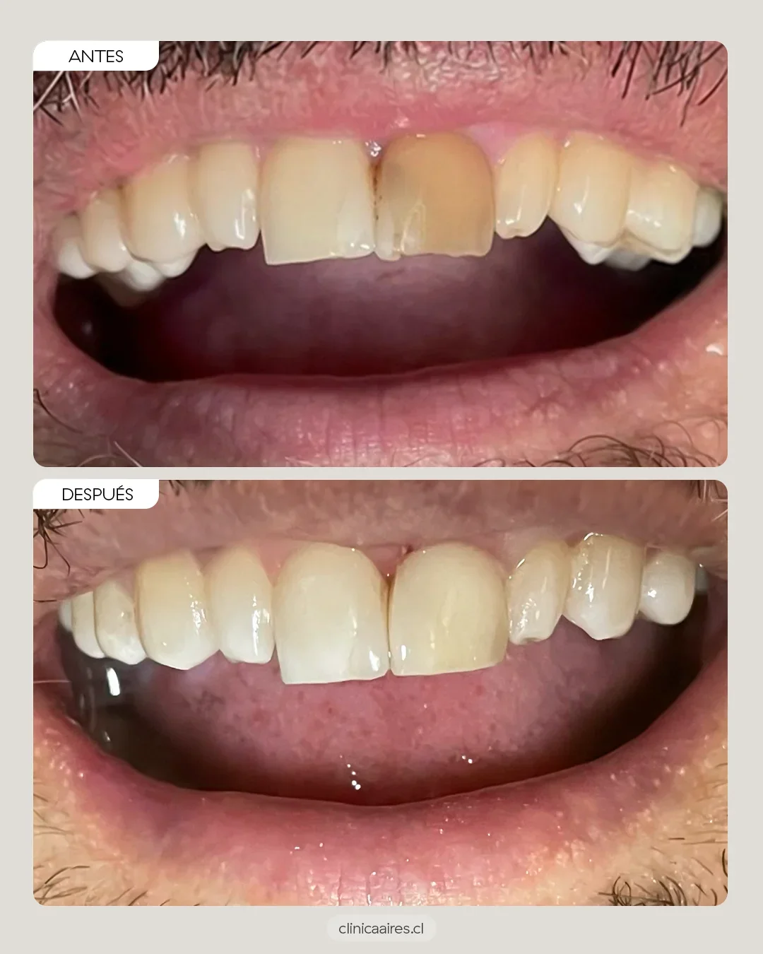 antes y después de blanqueamiento dental interno en un paciente hombre