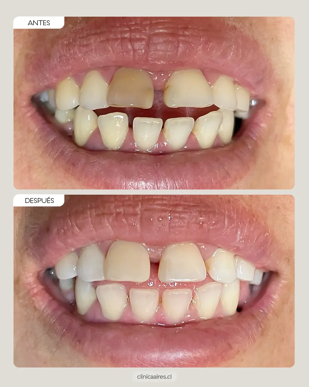 antes y después de blanqueamiento dental interno en una paciente mujer