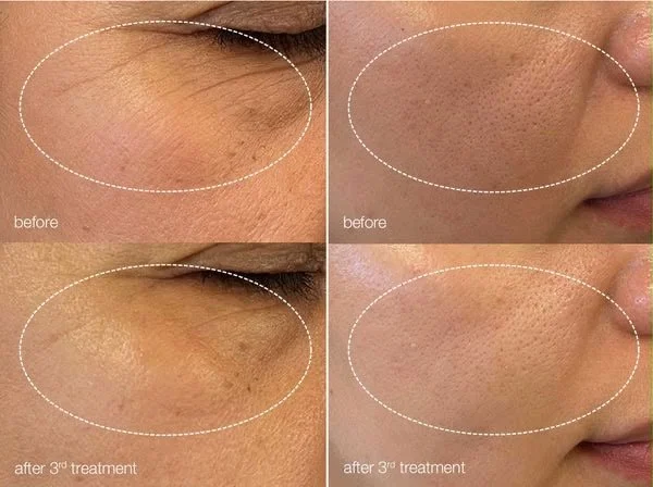 Luminfusion Before and After, Advanced professional skin treatment in Hereford. Dermalogica professional skin therapist