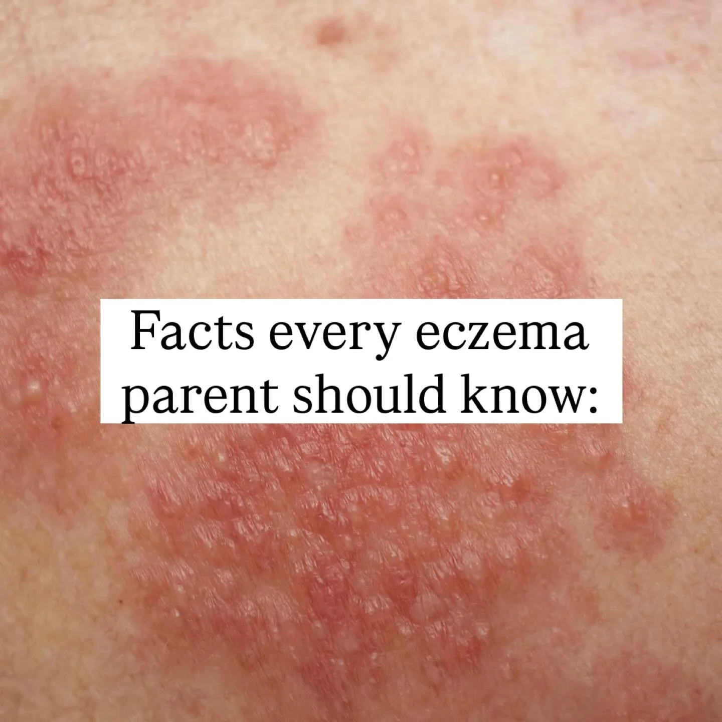 I&rsquo;m in the business of getting you answers. 

DM &ldquo;ECZEMA&rdquo; to learn more about how I can support your child. I have worked with babies as young as 1 week old and adults of all ages ❤️