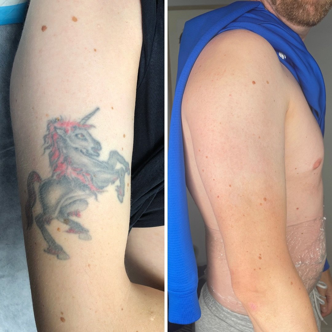 Working Magic for the last 11 years! 

Who said removal wasn&rsquo;t possible?! Trust us and the process and we won&rsquo;t lead you astray! 

Winter is our favourite time for removal and I promise it&rsquo;ll be yours too! Book in today to start you
