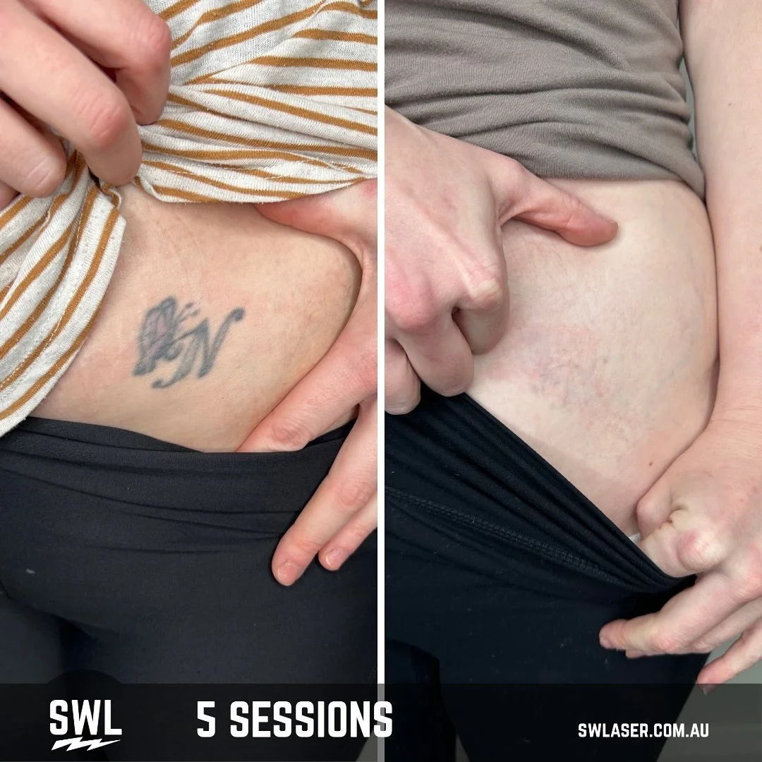 Reminders of your past don&rsquo;t need to be visible forever. Let us help you move forward with new beginnings! 

📍 Fremantle &amp; West Leederville
📱 0499 527 374
📧 info@swlaser.com.au 
GET YOUR FREE QUOTE TODAY!
