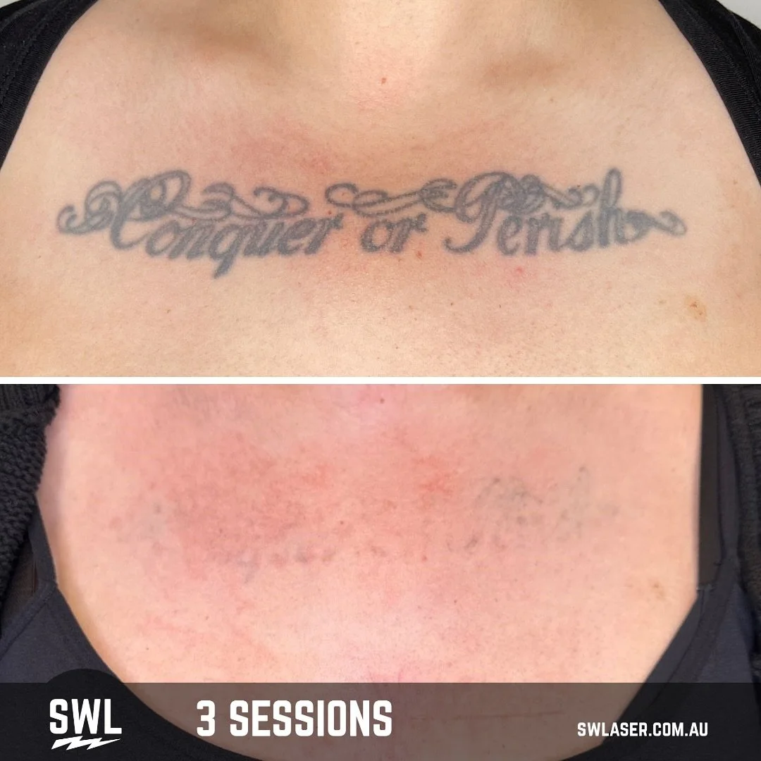 BOOM BOOM POW! ⚡️ 

If you needed a sign to start your laser tattoo removal journey, HERE IT IS!!

📍 Fremantle &amp; West Leederville
📱 0499 527 374
📧 info@swlaser.com.au 
GET YOUR FREE QUOTE TODAY!
