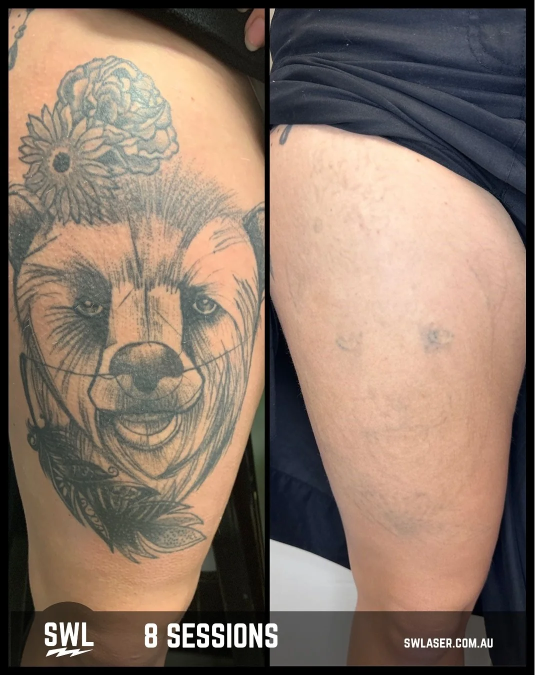 Sometimes it&rsquo;s the darker, denser pockets that require the most sessions to clear. The darker the area, the more laser it takes to achieve the same results as the lighter parts of your tattoo. Thankfully we&rsquo;re making great progress with t