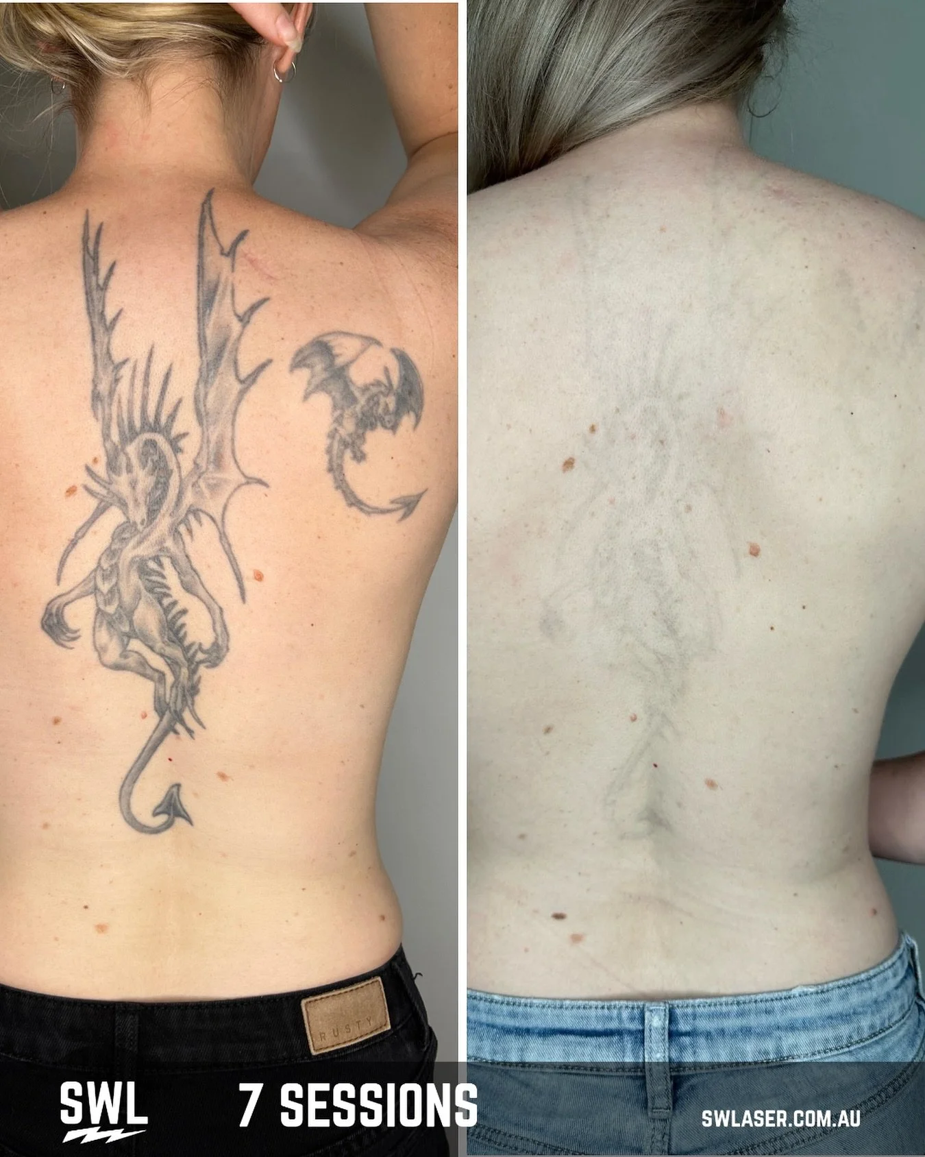 A great way to start the week seeing these results! 

📍 Fremantle &amp; West Leederville
📱 0499 527 374
📧 info@swlaser.com.au 
GET YOUR FREE QUOTE TODAY!