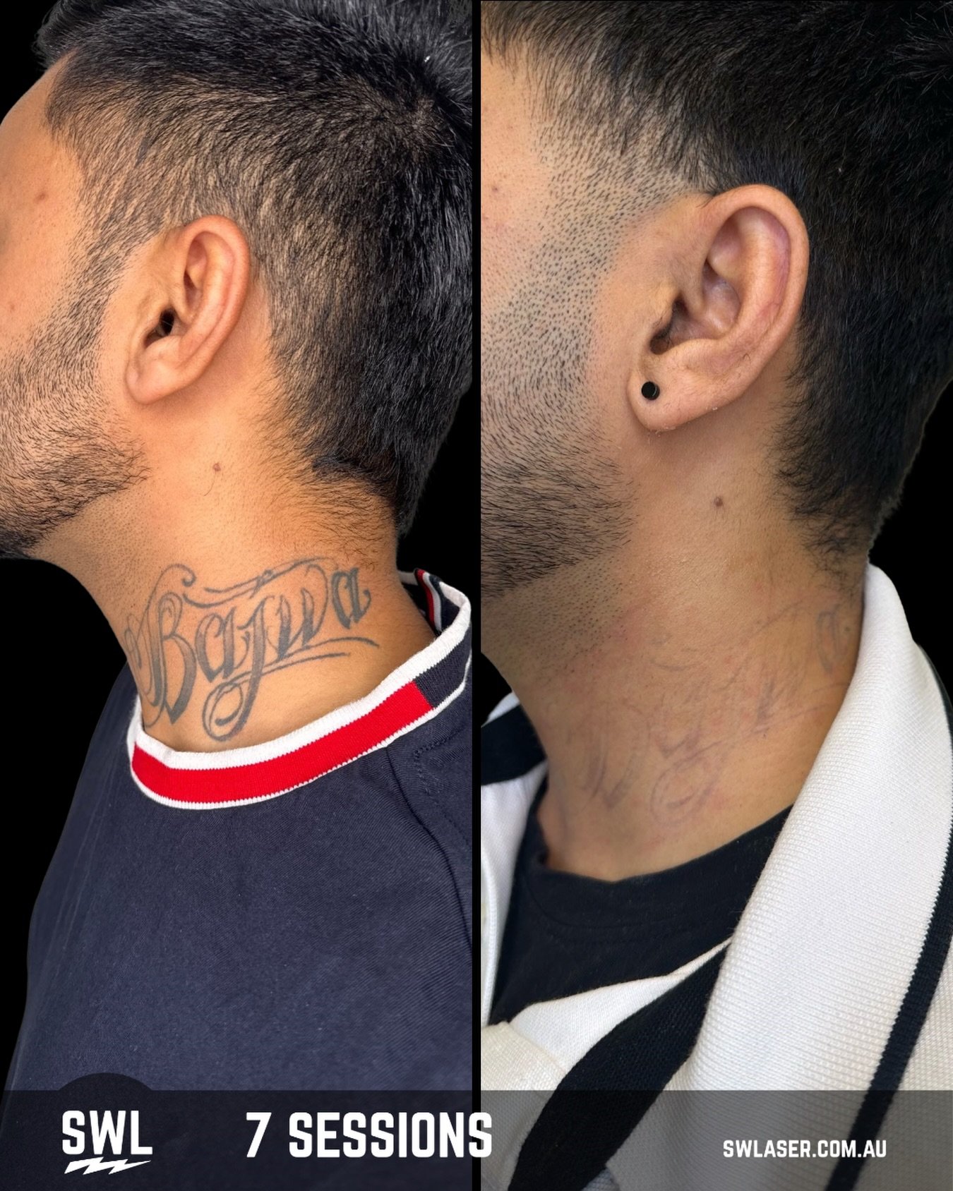 Laser tattoo removal on darker skin types needs extra skill and the right technician makes all the difference.

More melanin means your skin absorbs more laser energy, so choosing someone experienced helps protect you from pigment changes and unneces