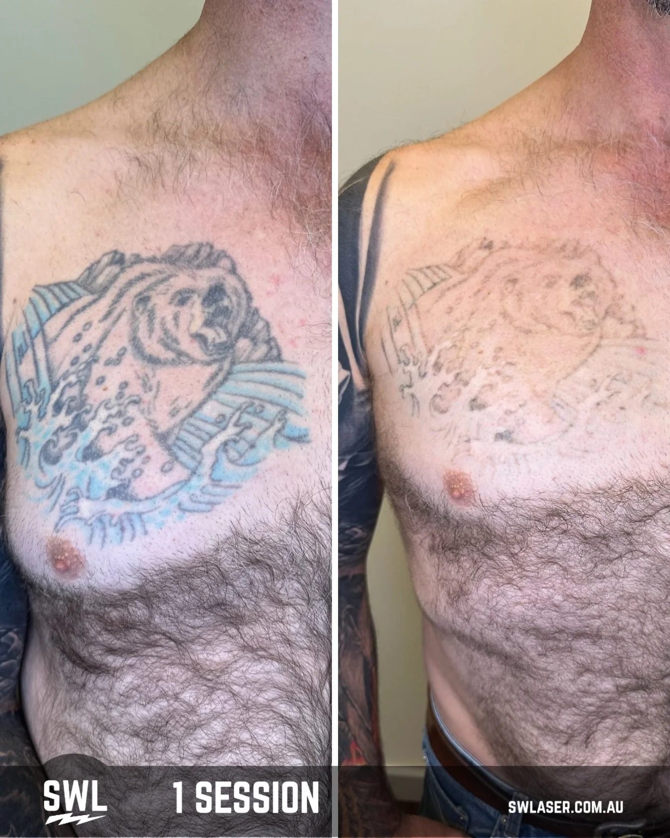 Like we always say LET THE RESULTS DO THE TALKING! 

Book in now to start your laser journey!