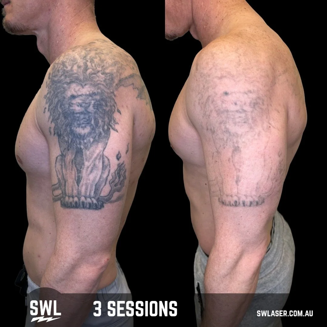 Cover up Ready for @jserafino ! 2026 New year, New You! Book in today! 

📍 Fremantle &amp; West Leederville
📱 0499 527 374
📧 info@swlaser.com.au 
GET YOUR FREE QUOTE TODAY!