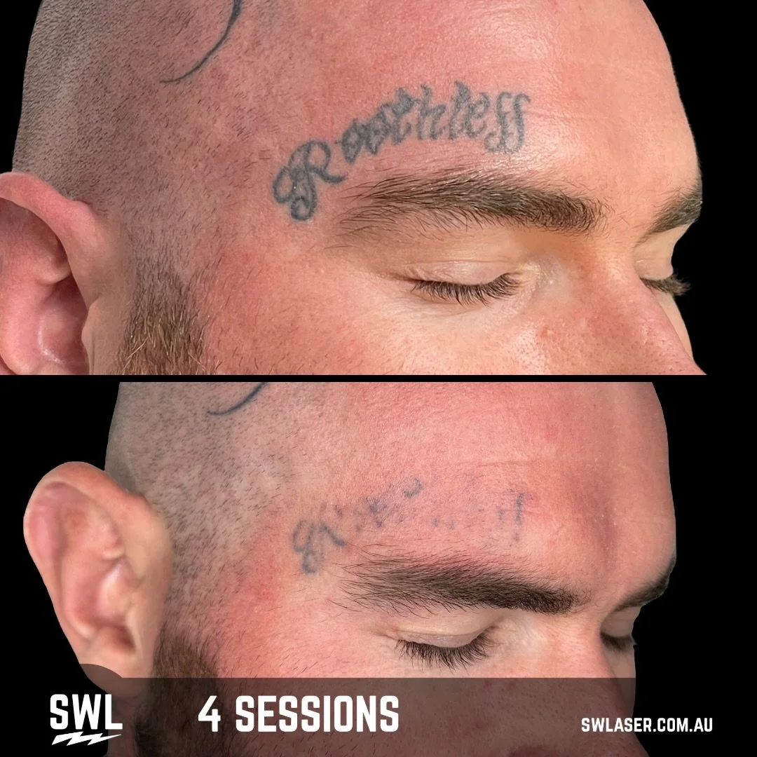 Nothing better than seeing some epic results with minimum sessions!

Start the new year right and get yourself booked in! 

📍 Fremantle &amp; West Leederville
📱 0499 527 374
📧 info@swlaser.com.au 
GET YOUR FREE QUOTE TODAY!