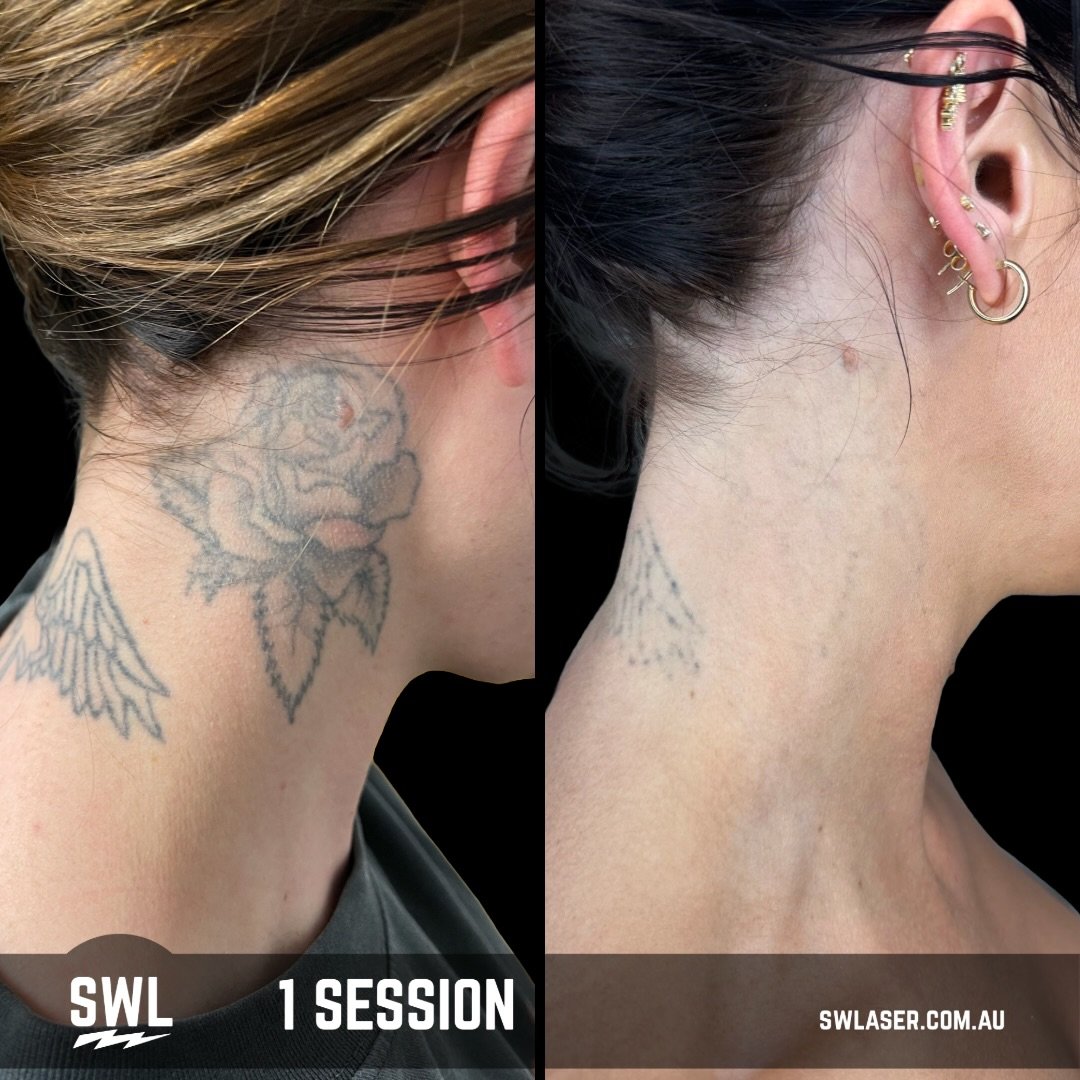 Making magic since 2013!!

We got to see this rose tattoo today for the first time since 2021 and we are so happy to see the fade! She loved her results so much we are going to laser some more and we are so excited!