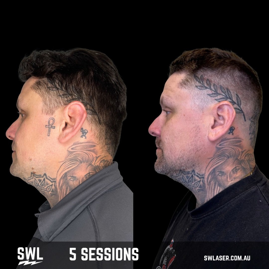 Looking for a fresh start or maybe you just want to change things up? 

We got you covered! As you can see, the sooner you start the sooner it&rsquo;s gone. 

📍 Fremantle &amp; West Leederville
📱 0499 527 374
📧 info@swlaser.com.au 
GET YOUR FREE Q