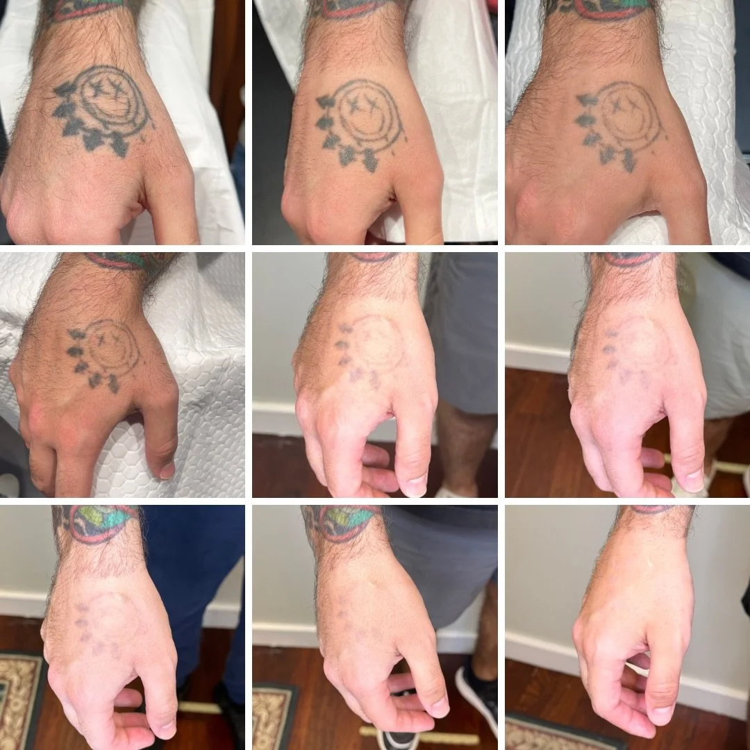 Patience is key in tattoo removal, but boy is it worth the wait. 

Let the results do the talking! 

📍 Fremantle &amp; West Leederville
📱 0499 527 374
📧 info@swlaser.com.au 
GET YOUR FREE QUOTE TODAY!