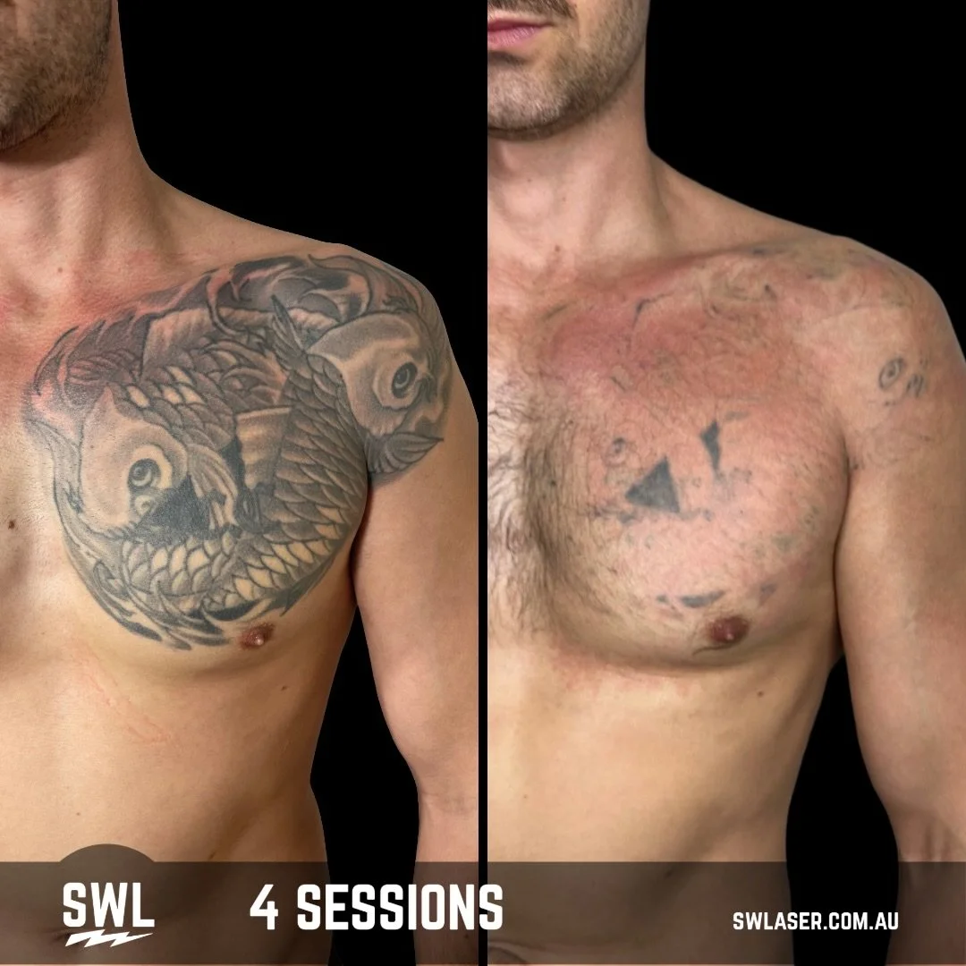 Let The Results Do The Talking!

Here at SWL we got you covered! 
📍 Fremantle &amp; West Leederville
📱 0499 527 374
📧 info@swlaser.com.au 
GET YOUR FREE QUOTE TODAY!
