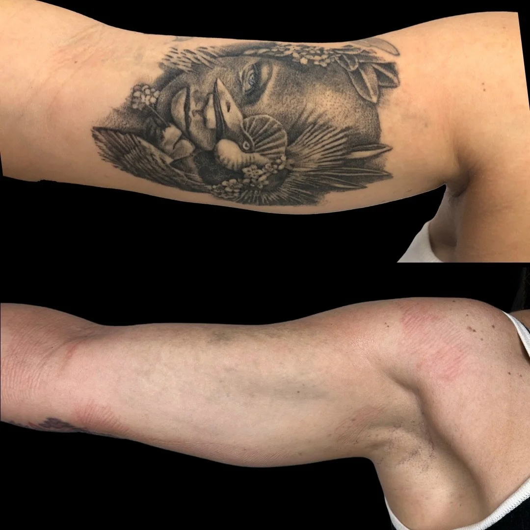 The sooner you start the sooner it&rsquo;s gone! 

Nerves and the fear of the unknown with laser is super common. Reach out to us anytime to discuss a FREE quote, expectations, and the process of tattoo removal/lightening. 

Knowledge is power and we