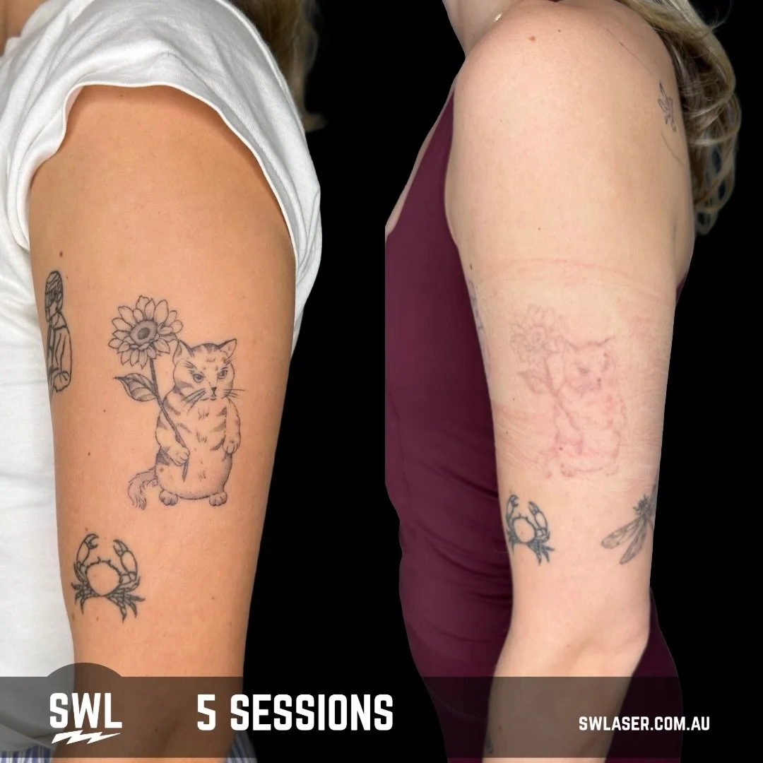 The Magic Of Laser Tattoo Removal! Sometimes A Few Sessions Can Go A Long Way! ⚡️