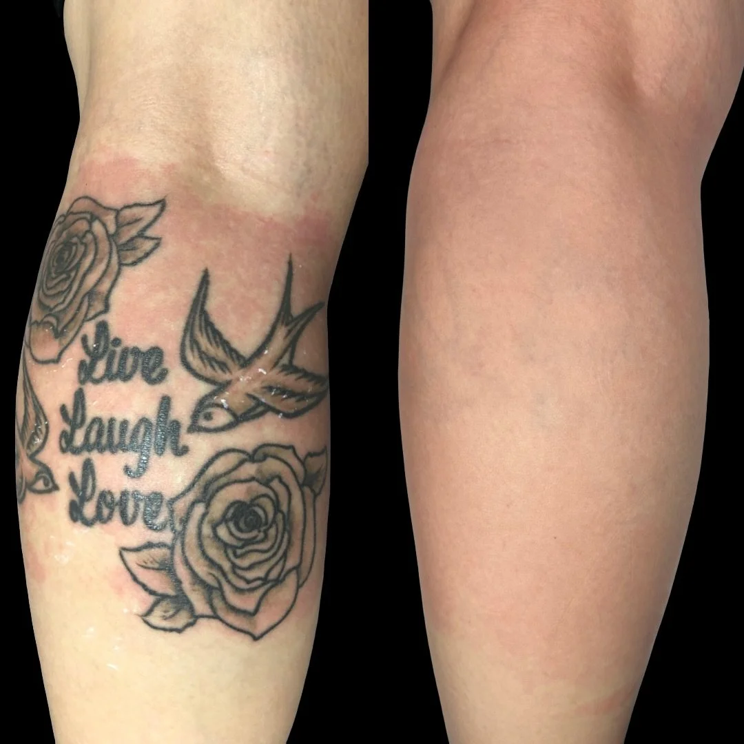 Winter is your secret weapon for laser tattoo removal ❄️

Less sun = safer treatments &amp; better healing. Plus, it&rsquo;s the perfect time to stay consistent while your skin&rsquo;s covered so by summer, you&rsquo;re already ahead.

Start now, see