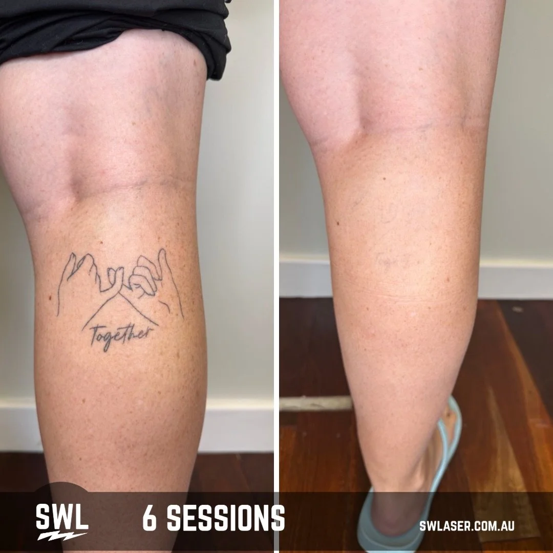 Another day in the office! Making tattoo removal dreams come true! 

📍 Fremantle &amp; West Leederville
📱 0499 527 374
📧 info@swlaser.com.au 
GET YOUR FREE QUOTE TODAY!