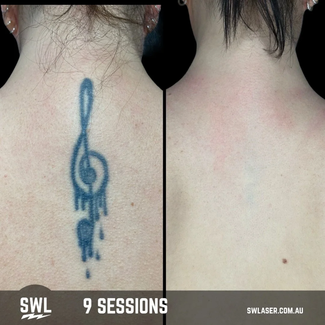 Swipe to see the progress. ➡️

This tattoo took a few sessions to really break through and show some Instagram worthy results, but once we cracked the code the results spoke for themselves. 

The sooner you start the sooner it&rsquo;s gone! ⚡️