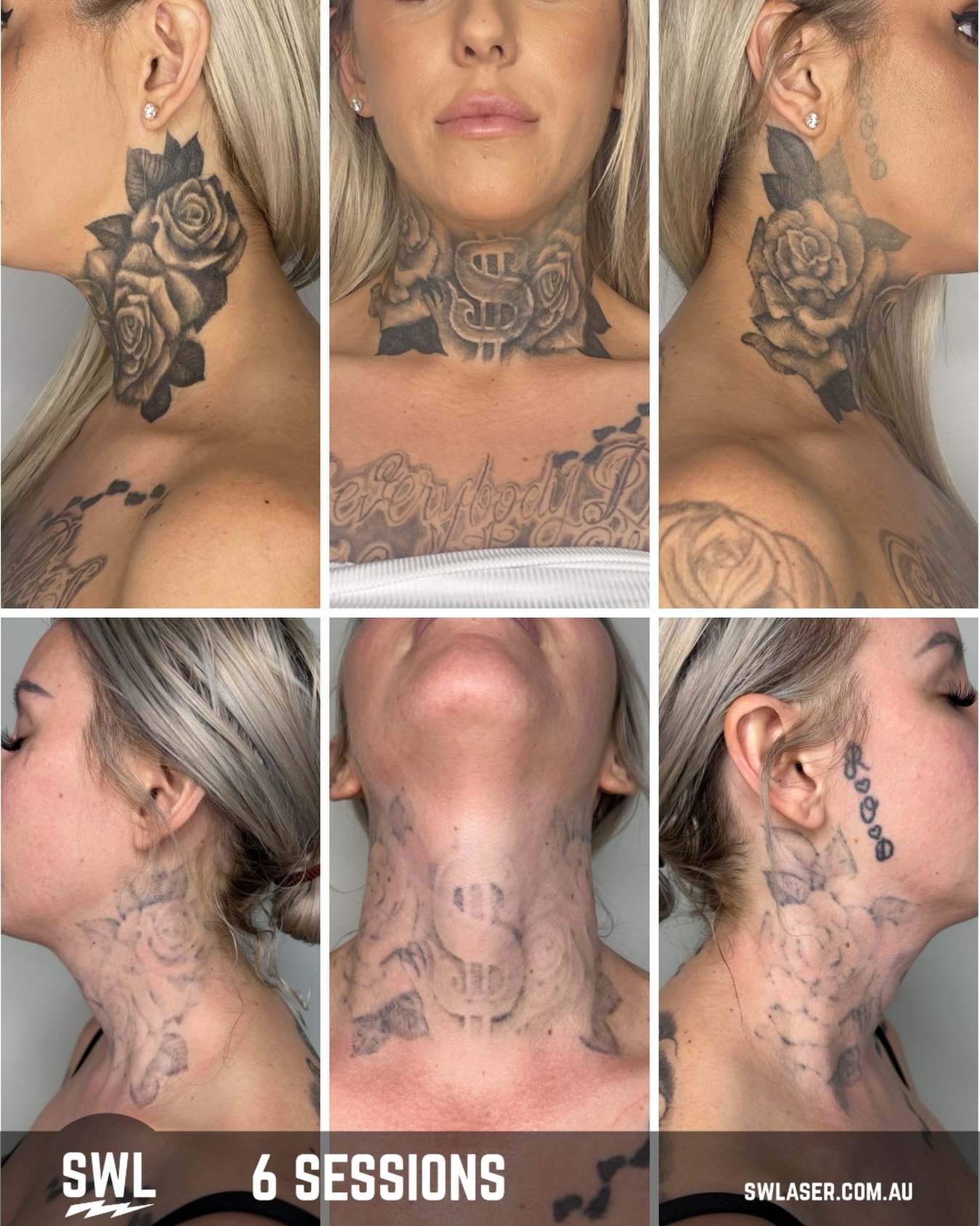 ❄️ Winter is hands down the BEST time to start laser tattoo removal.

With less sun exposure, it&rsquo;s much easier to keep your tattoo protected between sessions, reducing the risk of pigmentation issues and helping your skin heal at its best.

It 