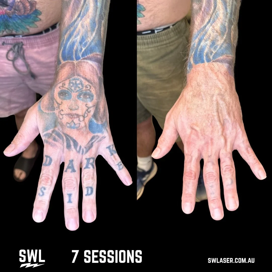 Colour? 🌈 

No Worries! We got you covered! Fremantle &amp; West Leederville houses both Pico and Q Switch technology.

📍 Fremantle &amp; West Leederville
📱 0499 527 374
📧 info@swlaser.com.au 
GET YOUR FREE QUOTE TODAY!