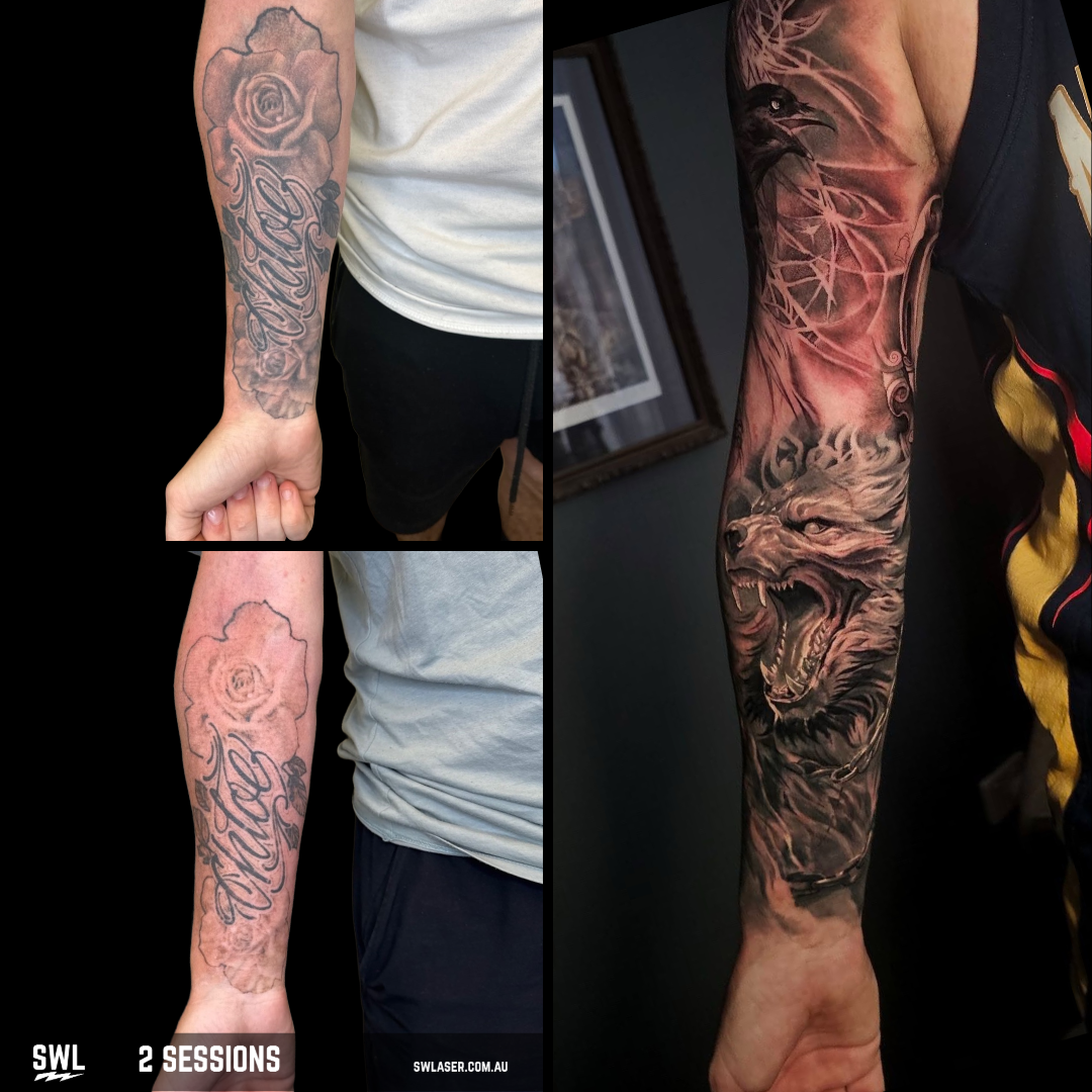 tattoo removal in perth cost