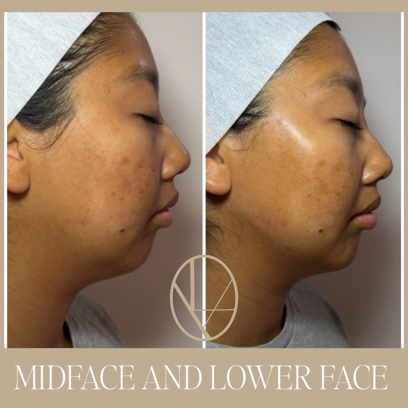 Before &amp; immediately after: We&rsquo;ve balanced mid- and lower-face volume to create natural harmony and address my clients goals&mdash;from subtle cheek volume to refined jawline and chin. Ready to discuss your own facial harmony? Book a consul
