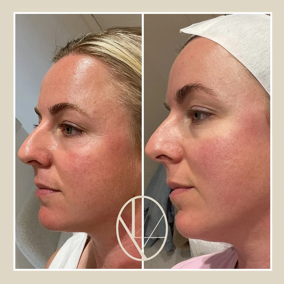 Consistent care and dedication pays off ✨

My beautiful client completed 3 Skin Needling sessions and 2 chemical peels, all tailored to her skin goals with quality skin care products used at home. 

Before and after taken 8 months apart &mdash; with 