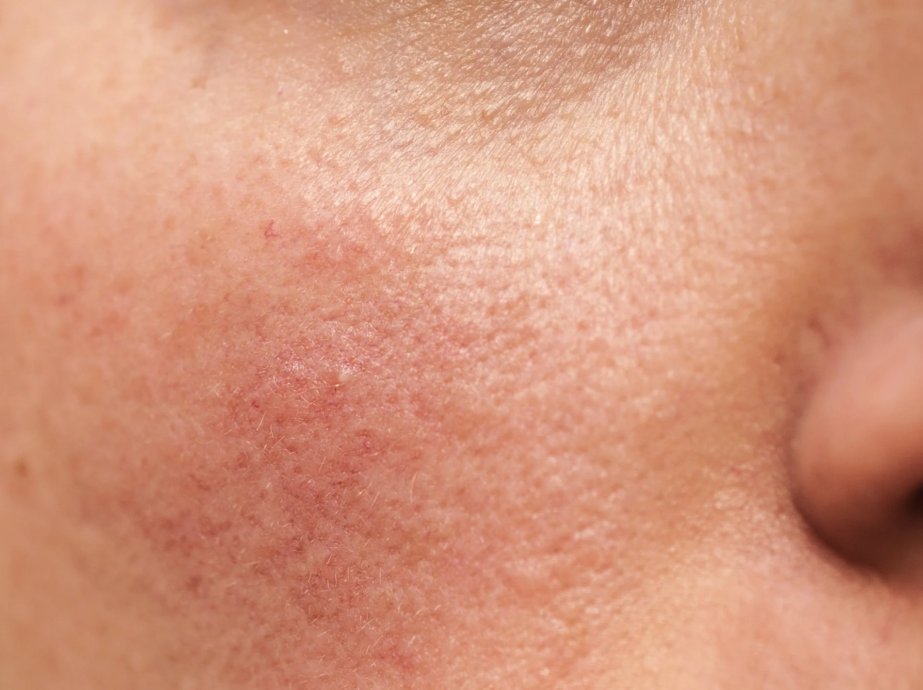 Rosacea/redness