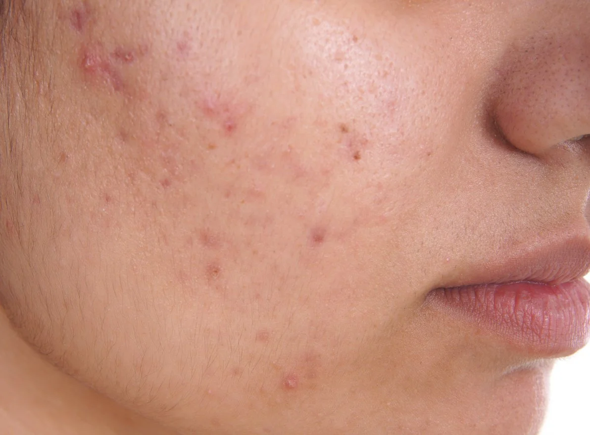 Close-up of a person's cheek with acne scars and blemishes.