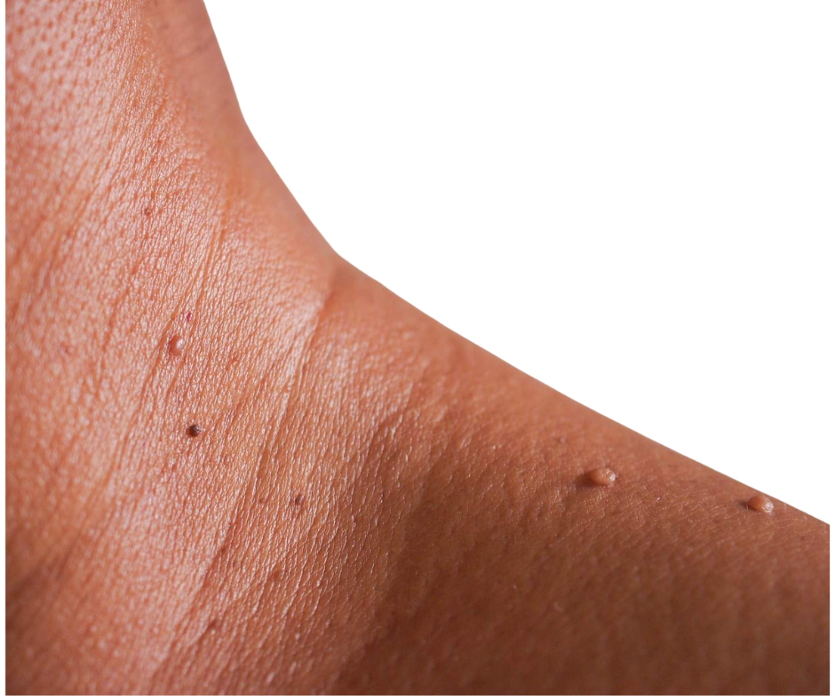 Close-up of skin with multiple small, raised, flesh-colored growths, possibly skin tags.