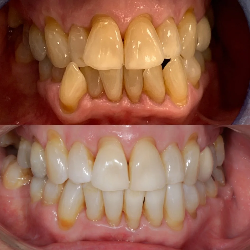 Invisalign U+L.JPG